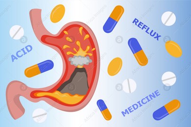 Heartburn treatment. Stomach illustration and antacid pills falling on light blue background. Erupting volcano symbolizing acid indigestion Illustration of Heartburn treatment. Stomach illustration and antacid pills falling on light blue background. Erupting volcano symbolizing acid indigestion