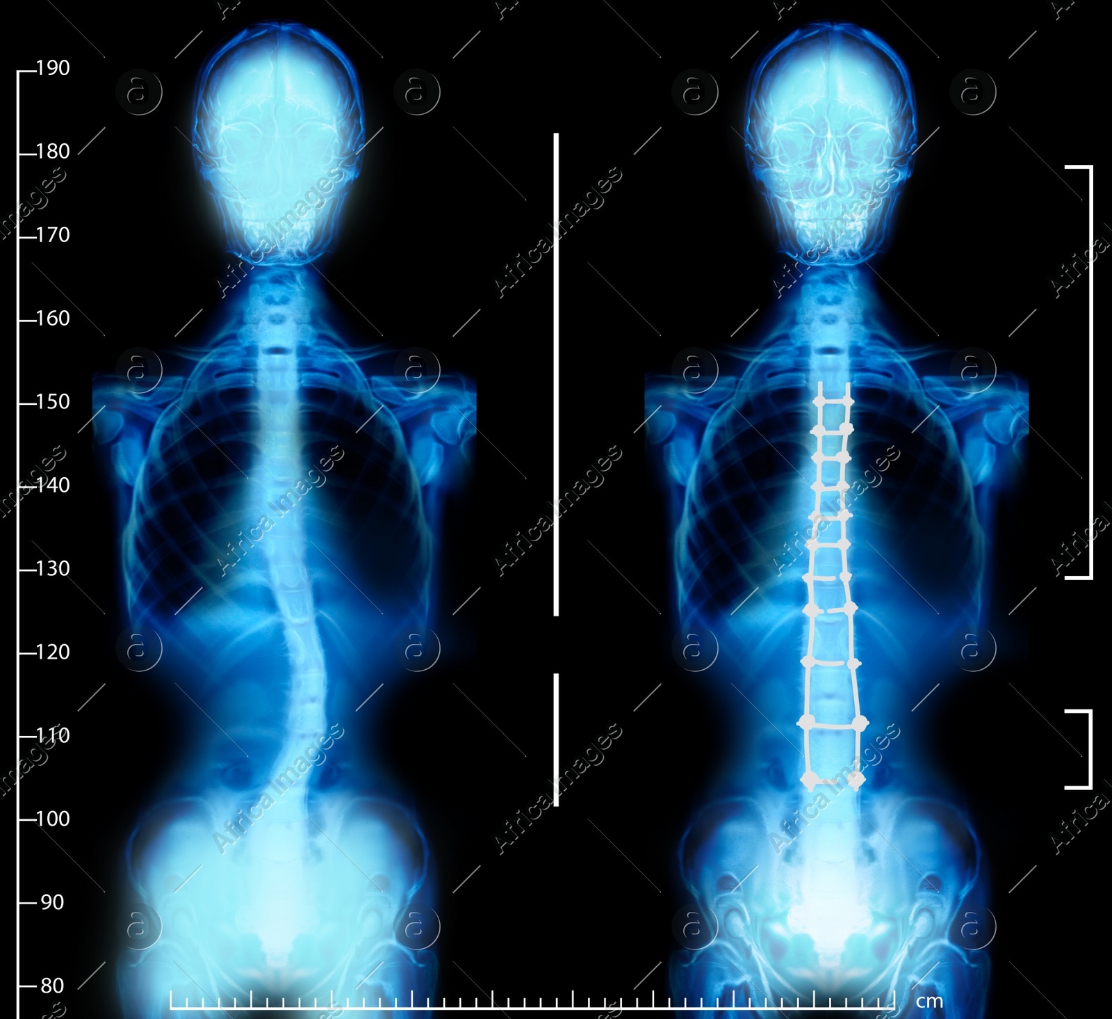 X-rays of human normal and curved spines. Patient suffering from scoliosis Illustration of X-rays of human normal and curved spines. Patient suffering from scoliosis