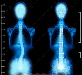 X-rays of human normal and curved spines. Patient suffering from scoliosis Illustration of X-rays of human normal and curved spines. Patient suffering from scoliosis