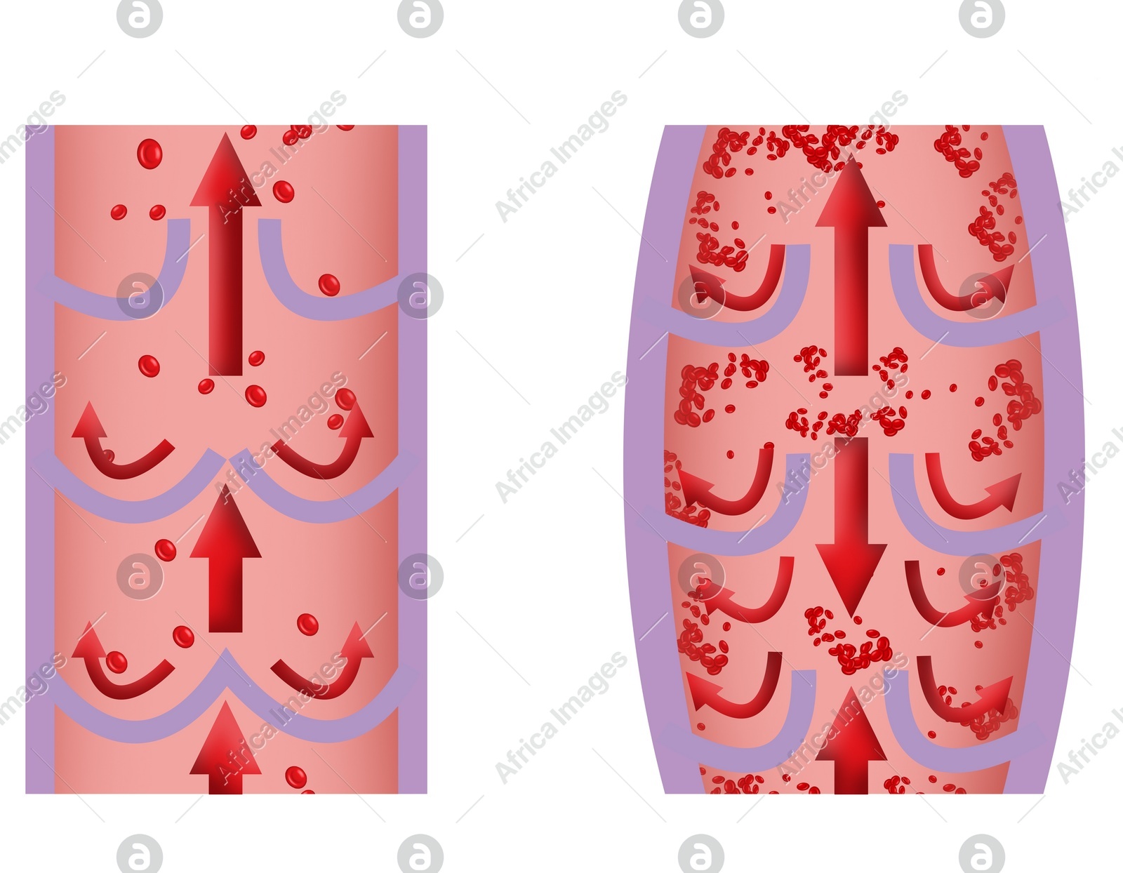 Illustrations of damaged and healthy vein on white background, longitudinal section Illustration of Illustrations of damaged and healthy vein on white background, longitudinal section
