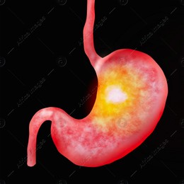 Illustration of diseased stomach on black background. Gastroenterology Illustration of diseased stomach on black background. Gastroenterology