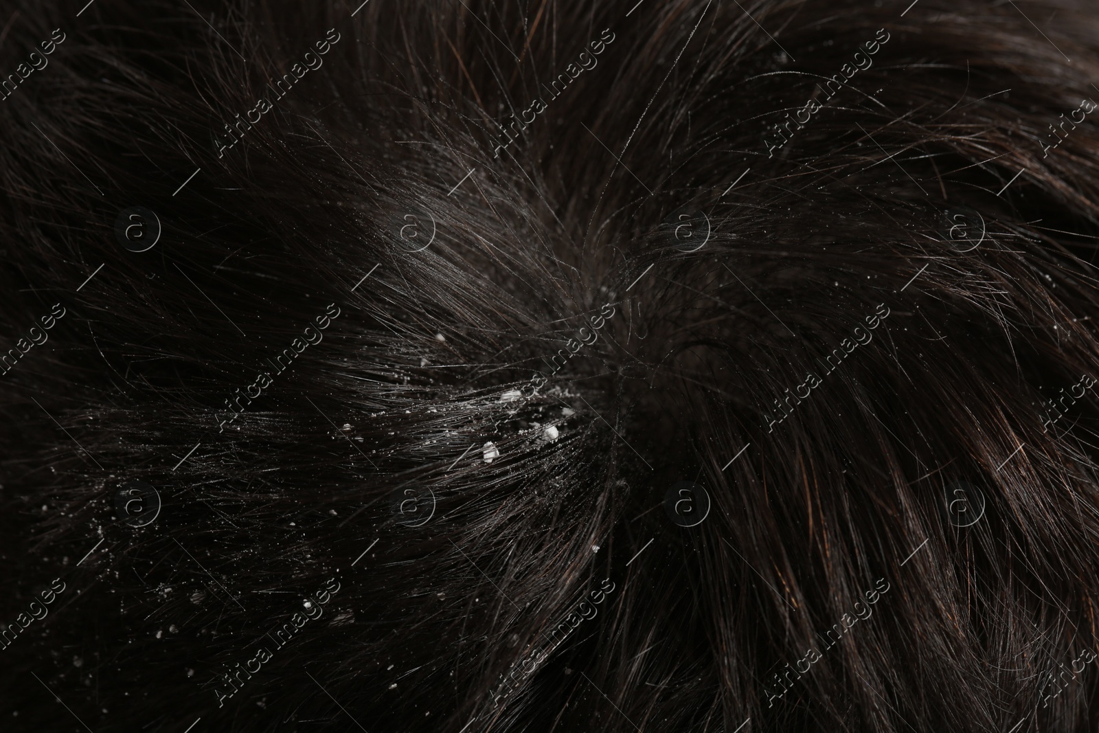 Man with dandruff in his dark hair, macro view Photo of Man with dandruff in his dark hair, macro view