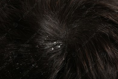 Man with dandruff in his dark hair, macro view Photo of Man with dandruff in his dark hair, macro view