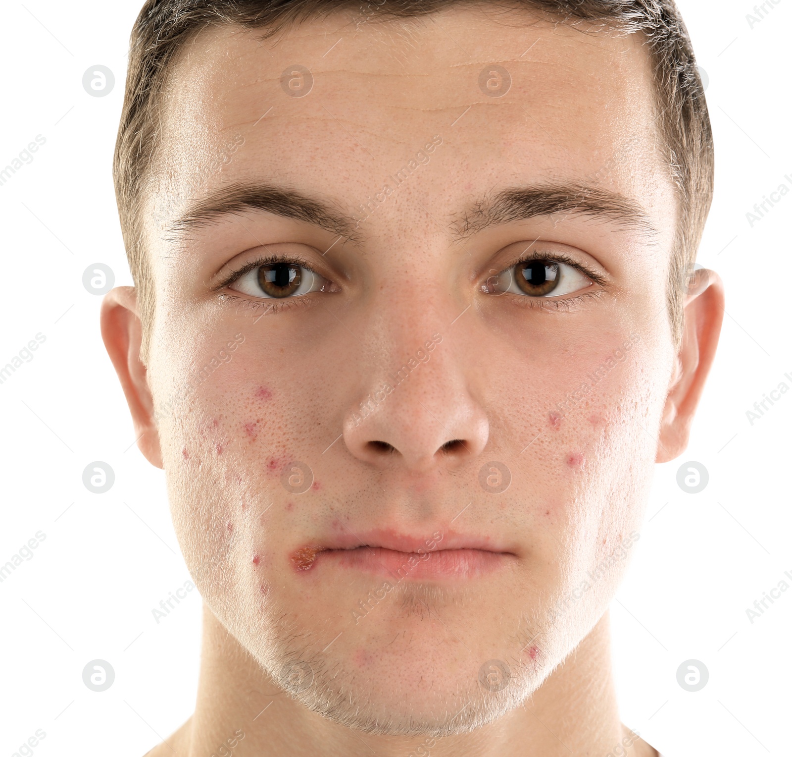 Photo of Young man with acne problem on white background