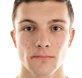 Young man with acne problem on white background Photo of Young man with acne problem on white background