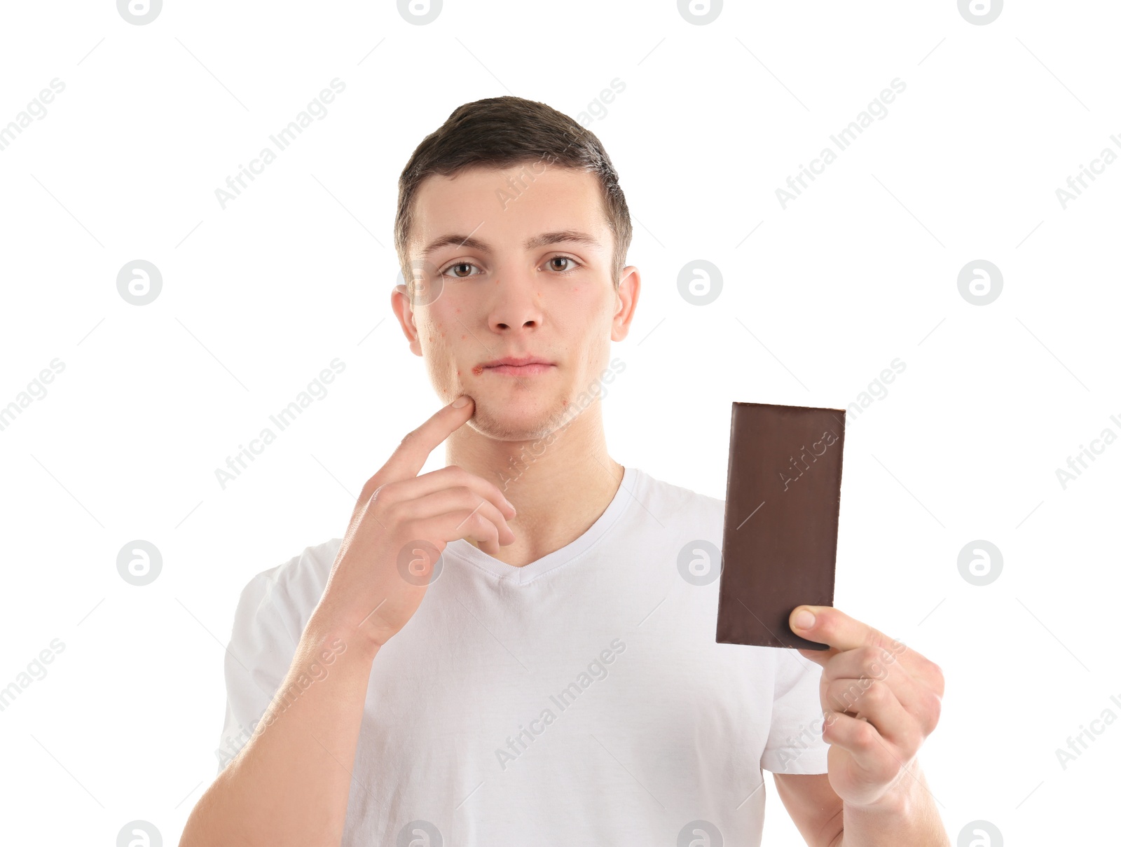 Young man with acne problem holding chocolate bar on white background. Skin allergy Photo of Young man with acne problem holding chocolate bar on white background. Skin allergy