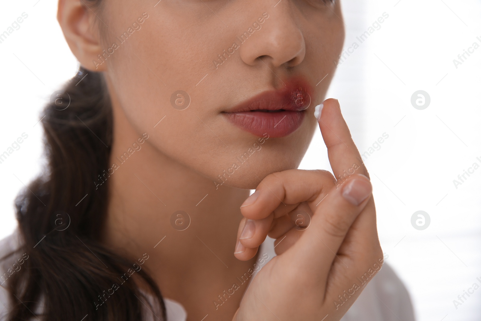 Woman with herpes applying cream on lips against light background, closeup Photo of Woman with herpes applying cream on lips against light background, closeup