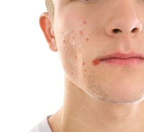 Young man with acne problem on white background Photo of Young man with acne problem on white background