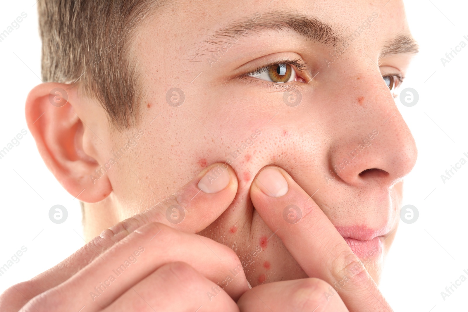 Photo of Young man squeezing acne on white background