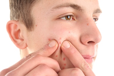 Young man squeezing acne on white background Photo of Young man squeezing acne on white background