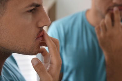 Man with herpes touching lips in front of mirror, closeup Photo of Man with herpes touching lips in front of mirror, closeup