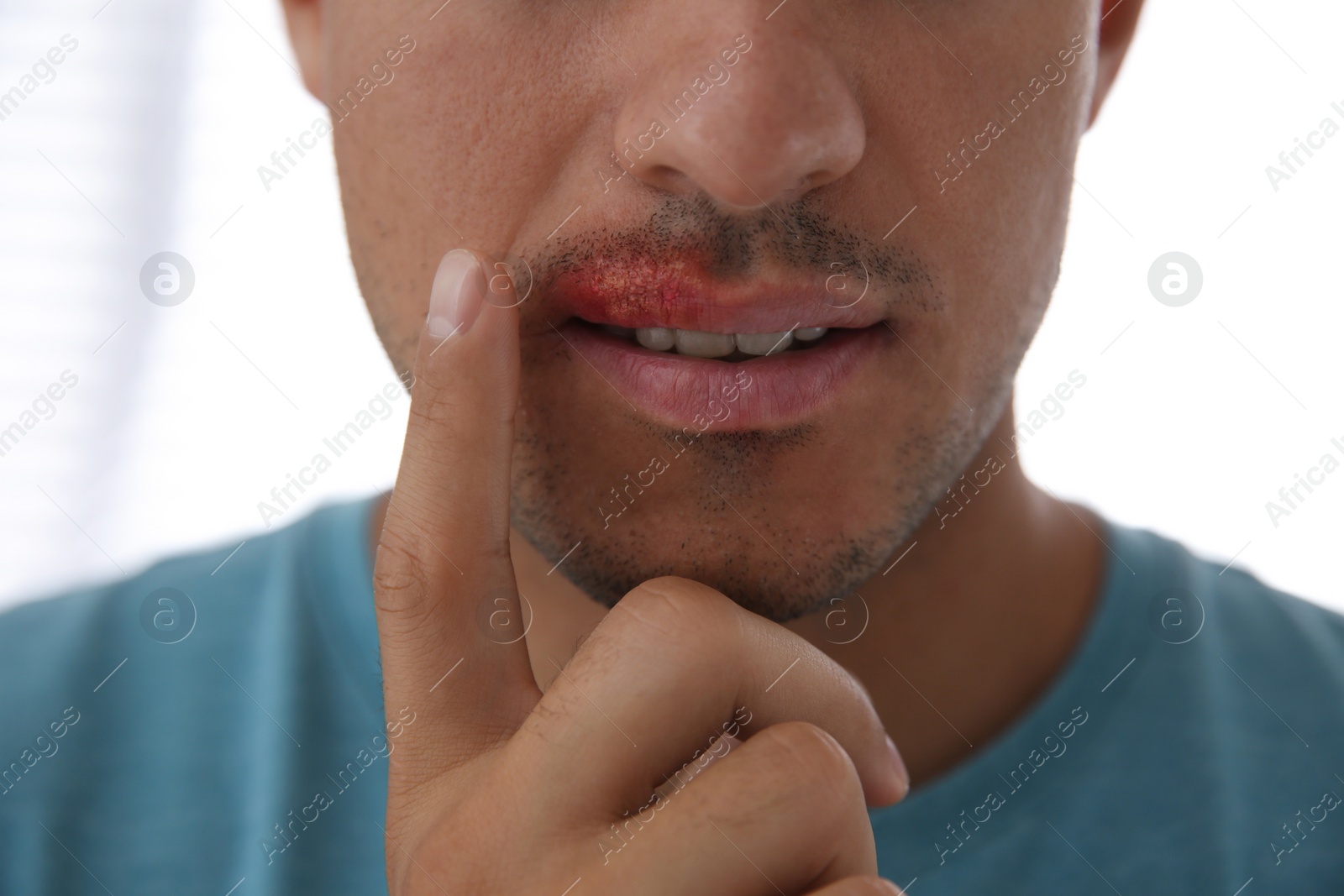 Man with herpes touching lips against light background, closeup Photo of Man with herpes touching lips against light background, closeup