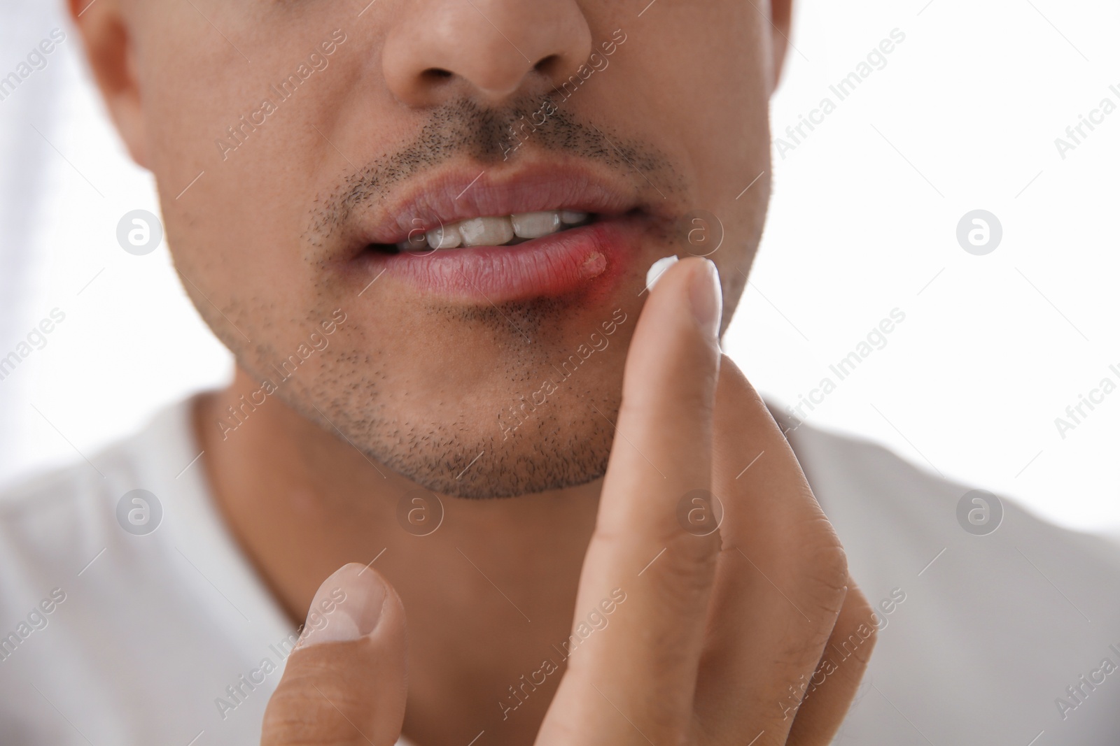 Man with herpes applying cream on lips against light background, closeup Photo of Man with herpes applying cream on lips against light background, closeup