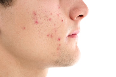 Young man with acne problem on white background Photo of Young man with acne problem on white background