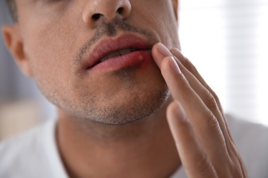 Man with herpes touching lips against blurred background, closeup Photo of Man with herpes touching lips against blurred background, closeup