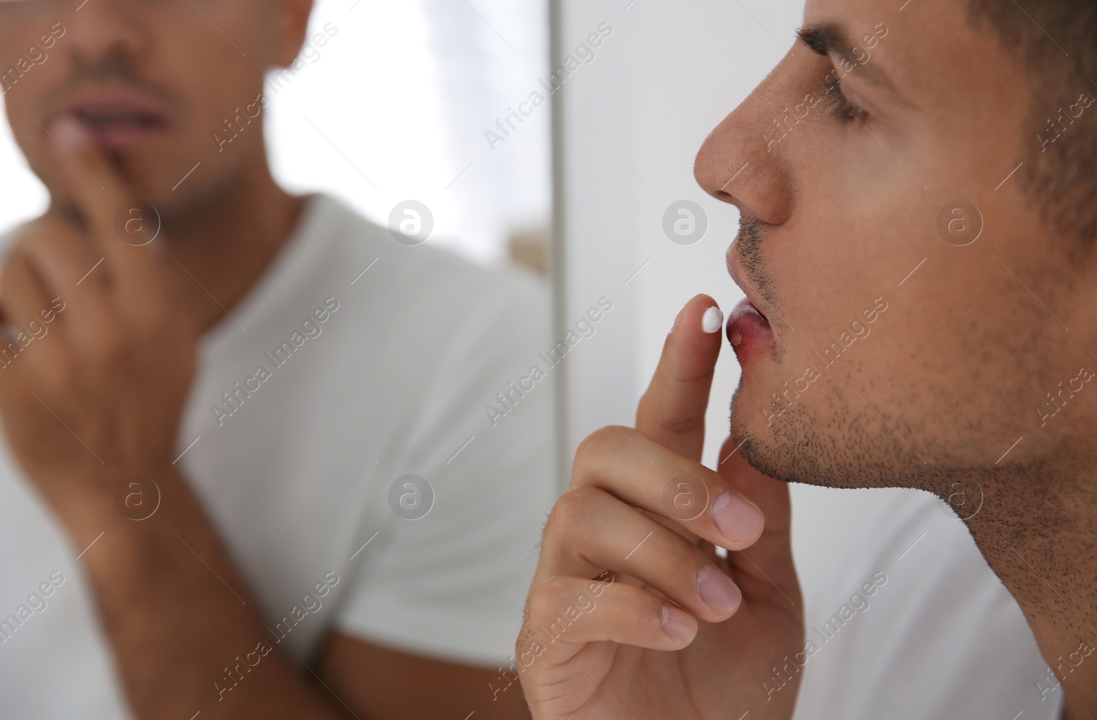 Man with herpes applying cream on lips in front of mirror, closeup Photo of Man with herpes applying cream on lips in front of mirror, closeup
