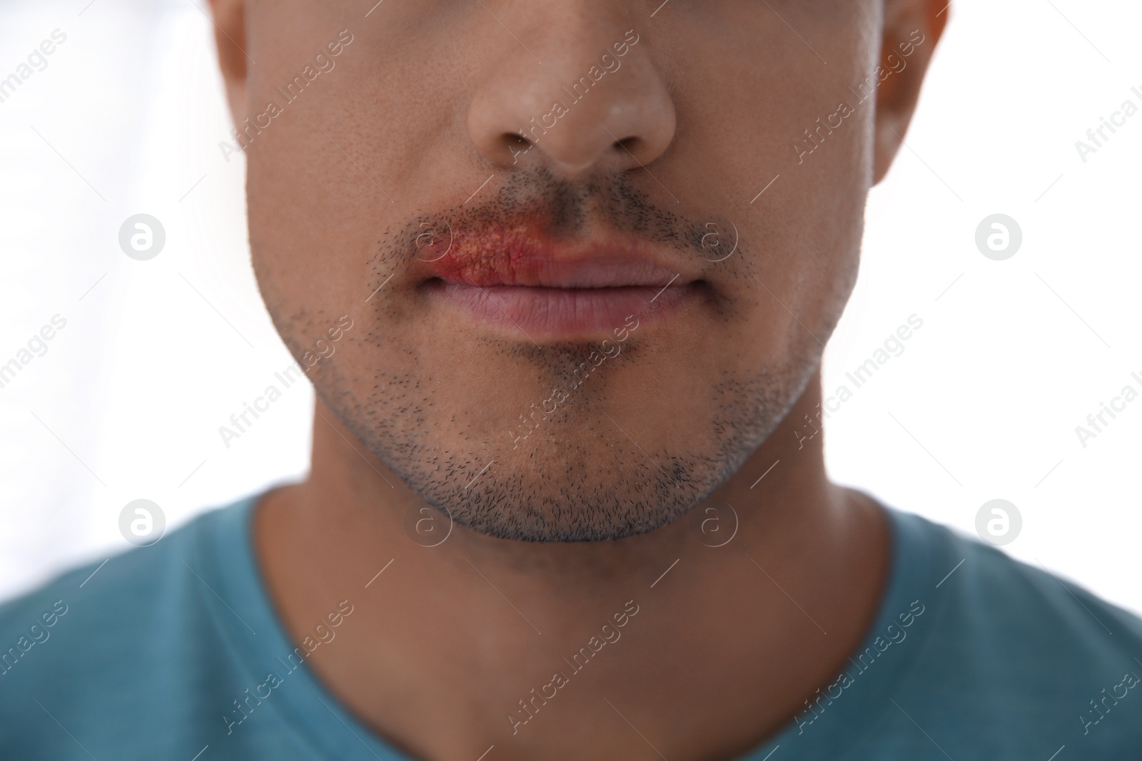 Man with herpes on lip against light background, closeup Photo of Man with herpes on lip against light background, closeup