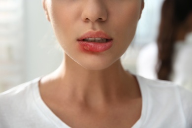 Woman with herpes on lip against blurred background, closeup Photo of Woman with herpes on lip against blurred background, closeup