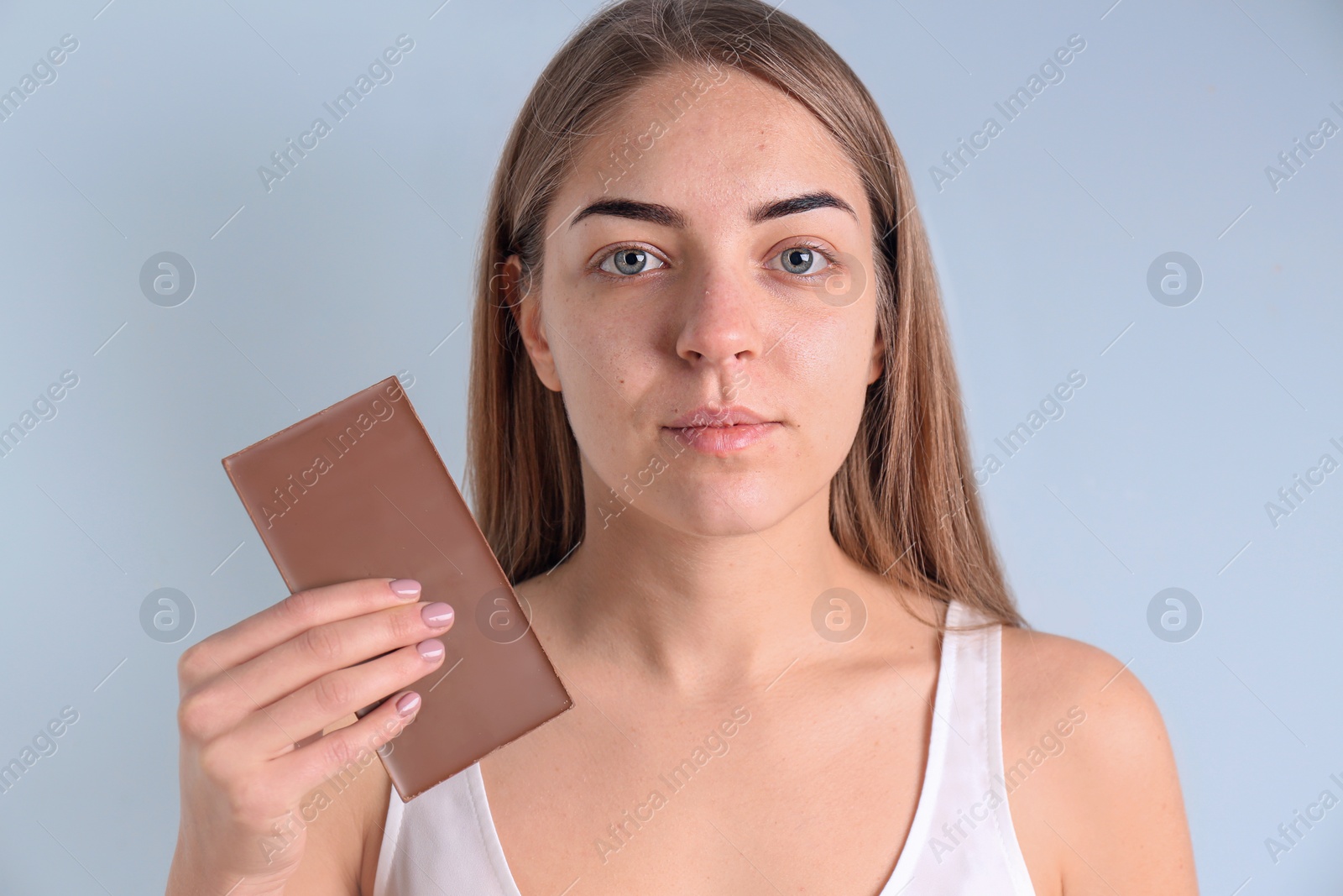 Young woman with acne problem holding chocolate bar on light background. Skin allergy Photo of Young woman with acne problem holding chocolate bar on light background. Skin allergy