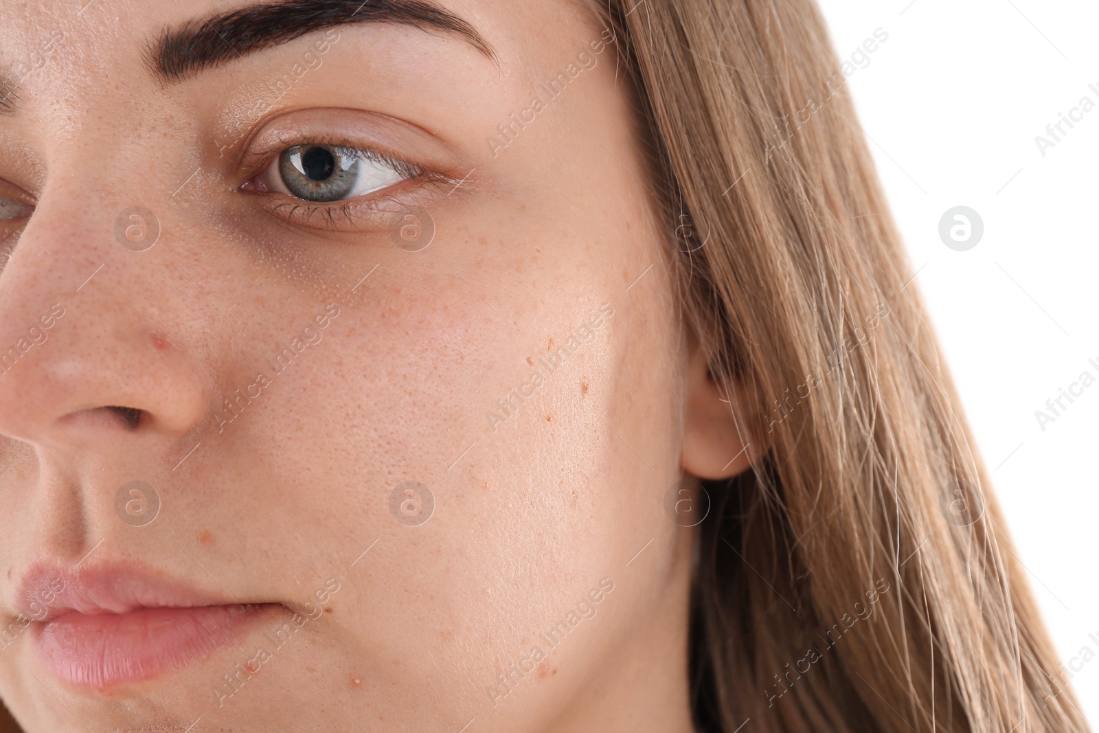 Young woman with acne problem on white background Photo of Young woman with acne problem on white background