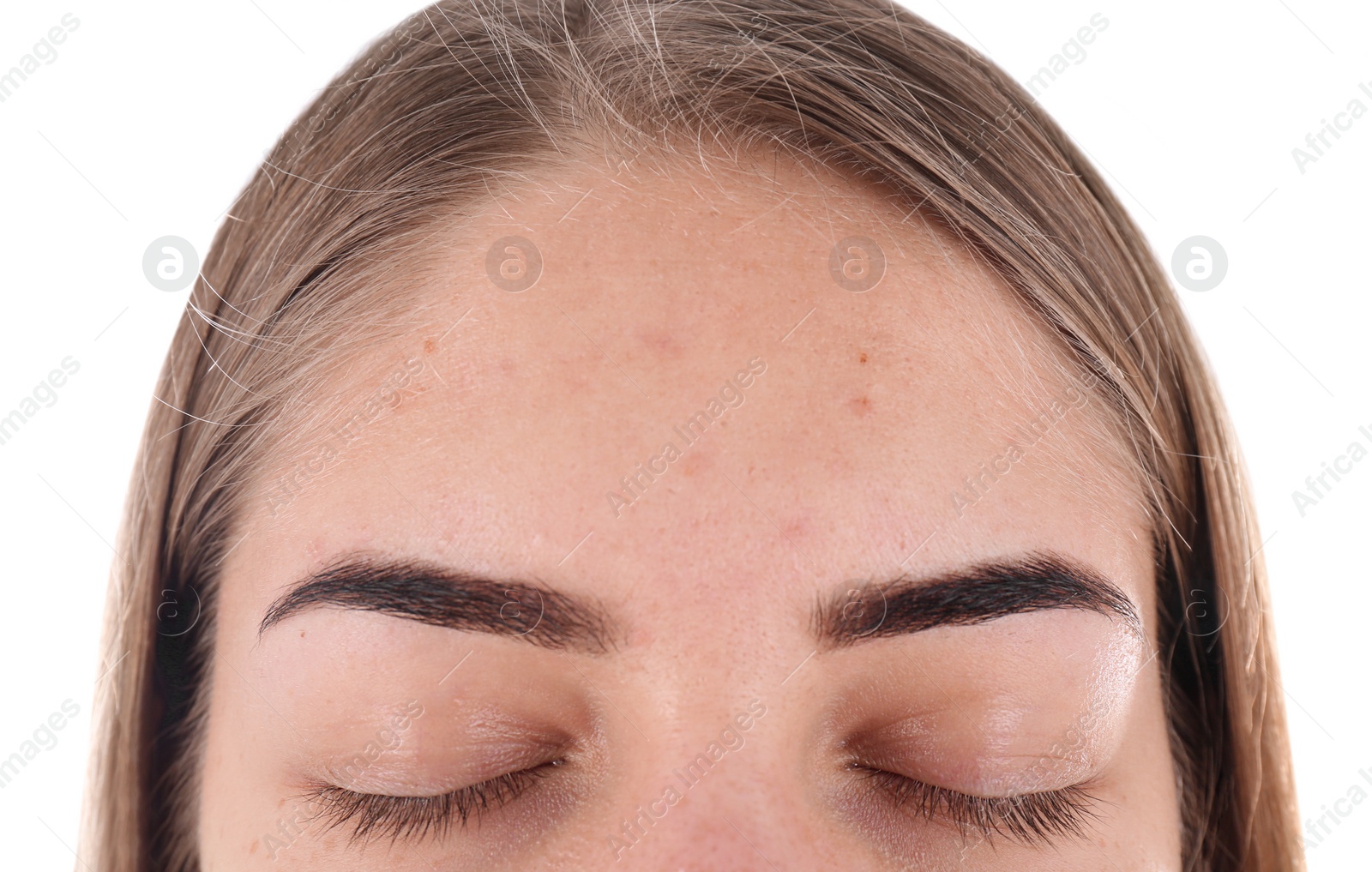 Young woman with acne problem on white background Photo of Young woman with acne problem on white background