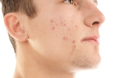 Young man with acne problem on white background Photo of Young man with acne problem on white background